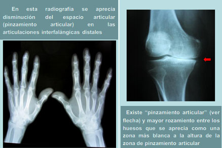 radiografia artritis